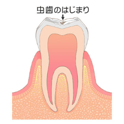 CO:初期むし歯