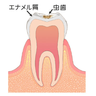 C1:エナメル質のむし歯