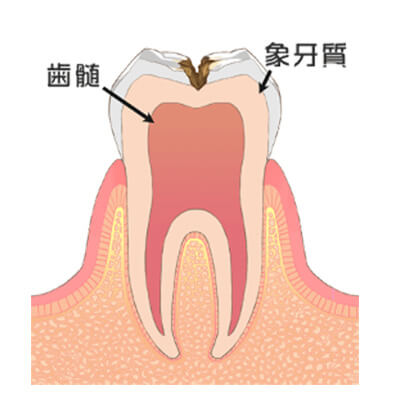 C2:象牙質まで進行したむし歯