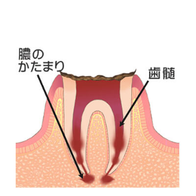 C4:歯の根だけが残った状態