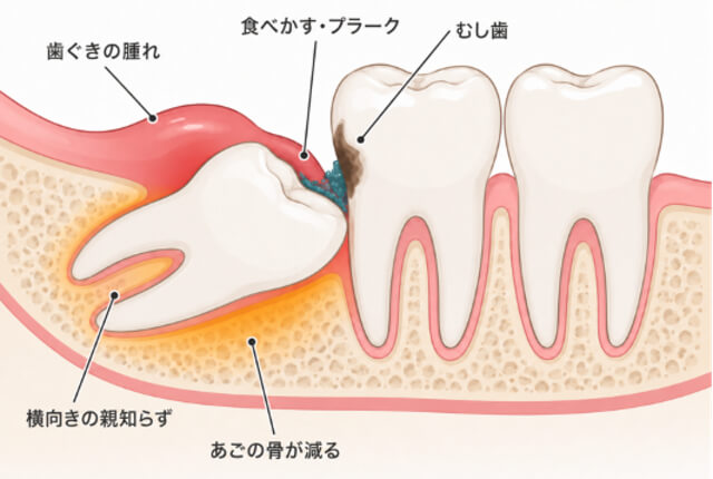 親知らずが原因のむし歯