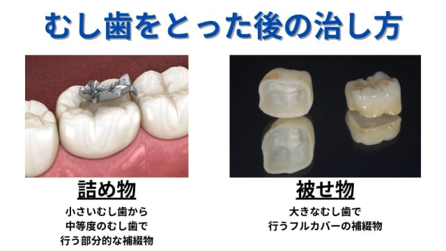 むし歯をとった後の治し方