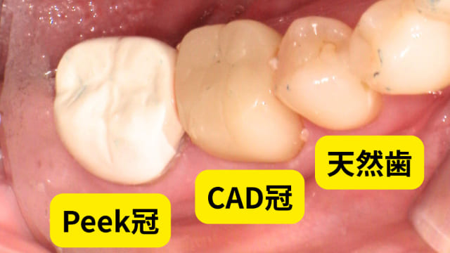 Peek冠 CAD/CAM冠 天然歯
