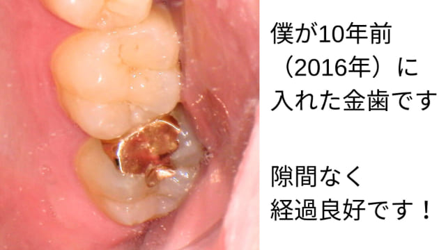 金歯