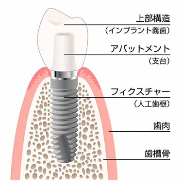 インプラントの構造
