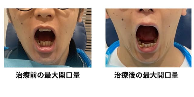 顎関節症治療のビフォーアフター