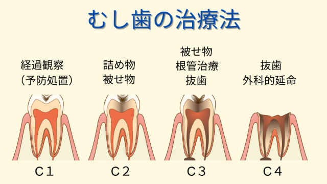 むし歯の治療法
