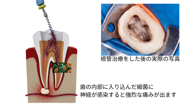 根管治療のイメージ図と治療後の写真