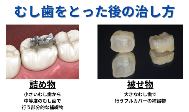 むし歯をとった後の治し方