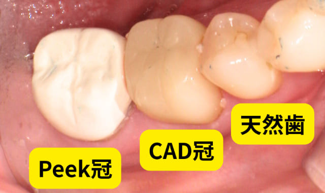 Peek冠 CAD/CAM冠 天然歯