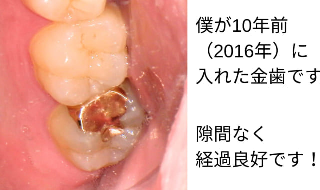 金歯
