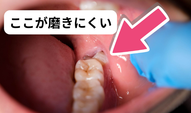 親知らずの周囲の磨きにくいところ