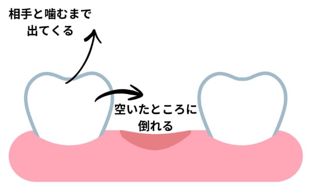 むし歯や歯の欠損で歯並びが乱れる様子