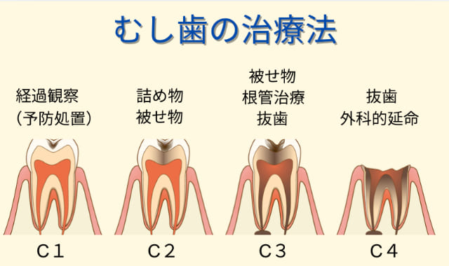 むし歯の治療法