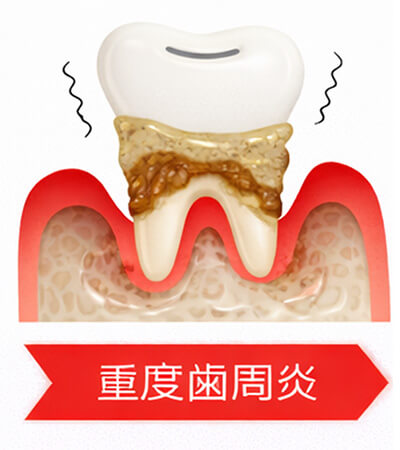重度歯周炎の模型