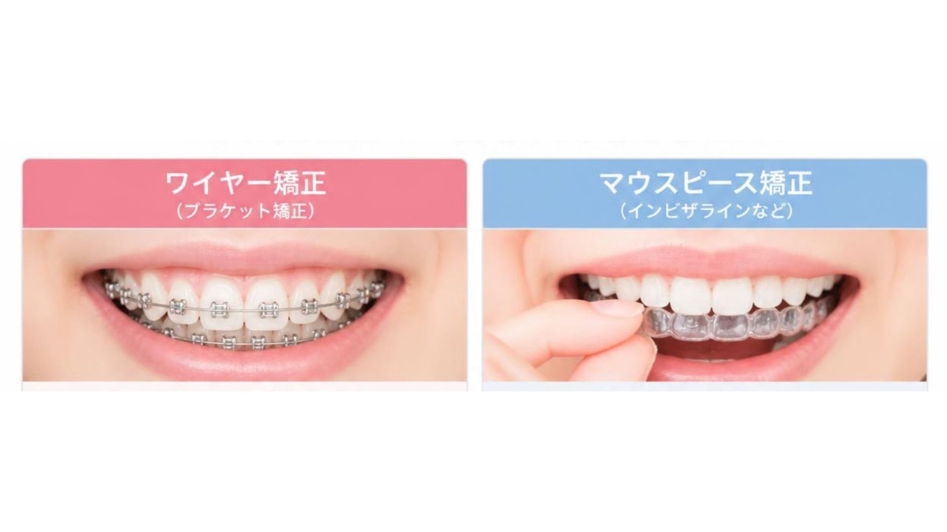 マウスピース矯正だけじゃない?ワイヤー矯正にも対応するメリット